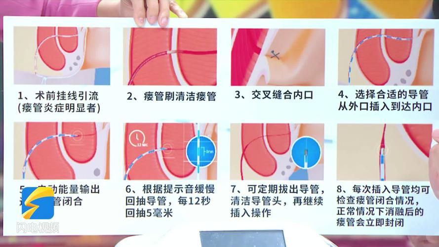 导尿管正确使用方法，安全又舒适（腹肌小奶狗导管正确使用方法）