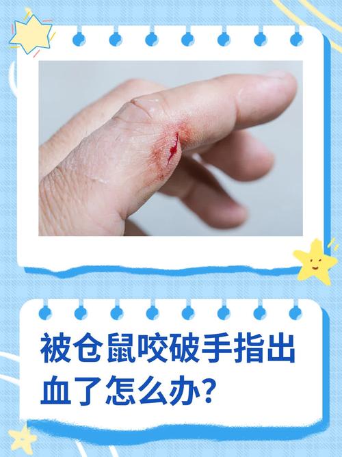仓鼠咬伤怎么办？速冲消毒防感染！（被家里养的小仓鼠咬了一口）