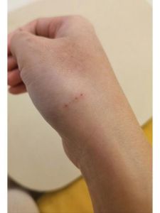 小狗狗抓伤别轻视，冲消毒打疫苗很重要！（被小狗狗爪子抓红了）
