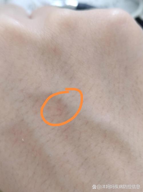 猫抓伤别慌，正确处理防感染（被猫不小心挠了一下）