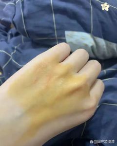 先洗后消，勤看别怕！（家猫抓破皮用碘伏消毒液可以吗）