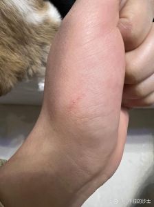 狗爪划伤别大意，及时清消毒打疫苗很重要！（被狗狗爪子划了一道）