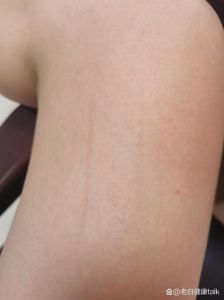 狗抓伤用流水清洗消毒，疼要警惕打疫苗（被家里养的狗抓了一条红痕怎么办）