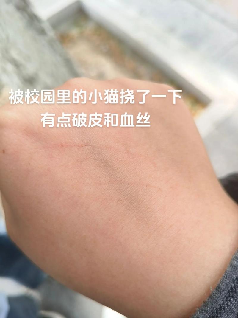 猫抓伤别慌,水洗消毒打疫苗!(被猫挠了怎么办) 猫抓伤别慌,水洗消毒打疫苗!(被猫挠了怎么办)