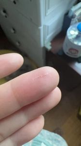 狗狗抓伤手怎么处理？（跟狗狗玩不小心被牙齿划破皮了）