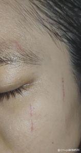被狗爪挠破脸？速冲消毒打疫苗！（脸被家里小狗的爪子挠破了）