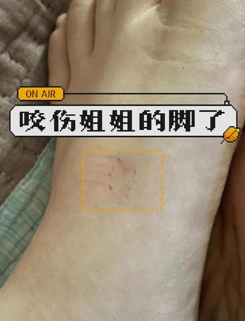 狗咬没破皮也洗消毒，关键部位及时看医生（不小心被狗狗咬了没流血没破皮）