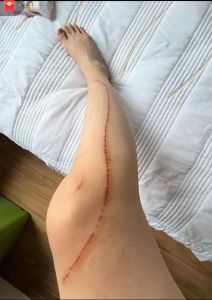 消毒防感染查过敏（猫咪挠了一下）
