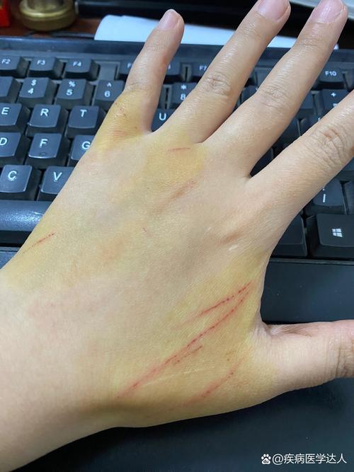 猫抓伤要当心，清创消毒很重要（被家养猫抓了一下轻微破皮出血）