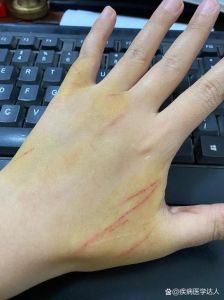猫抓伤要当心，清创消毒很重要（被家养猫抓了一下轻微破皮出血）