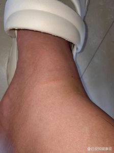脚踝被狗爪划伤？清洗消毒别忘，疫苗要打！（被家里的狗狗爪子划了一条红印）