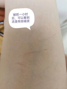 狗爪划伤别大意，清洗消毒打疫苗！（被狗爪子划了一条红印）