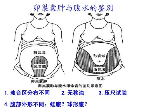 蛙状腹是什么病?需警惕!(蛙腹图片) 蛙状腹是什么病?需警惕!(蛙腹图片)