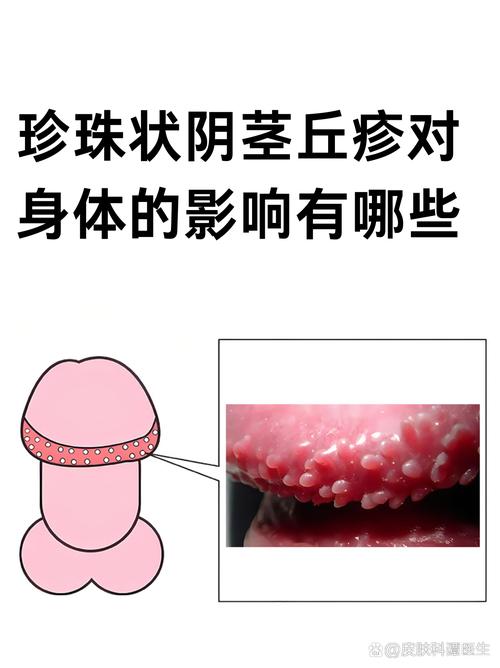 小疙瘩不痛,清洁干燥可自愈(龟的头上珍珠疹图片) 小疙瘩不痛,清洁干燥可自愈(龟的头上珍珠疹图片)