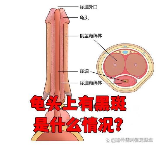 龟头黑斑?原因多,速就医!(龟 头上长了黑斑是怎么回事) 龟头黑斑?原因多,速就医!(龟 头上长了黑斑是怎么回事)