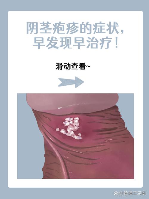 龟头水泡?快查查原因!(龟 头上长了小水泡图片) 龟头水泡?快查查原因!(龟 头上长了小水泡图片)