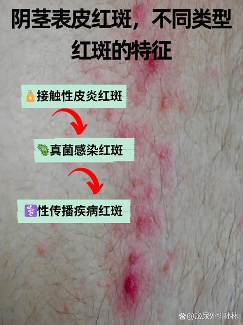 龟头红斑是什么原因引起的?(龟的头上长了红斑图片) 龟头红斑是什么原因引起的?(龟的头上长了红斑图片)