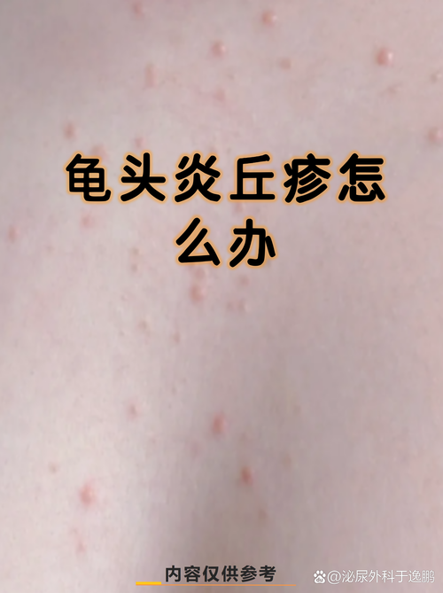 龟头湿疹症状多样,需综合治疗(龟 头上湿疹图片) 龟头湿疹症状多样,需综合治疗(龟 头上湿疹图片)
