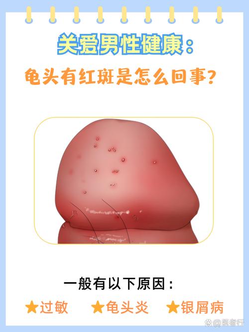 龟头红点?炎症惹的祸,及时就医早治疗!(龟的头上有小红点图片) 龟头红点?炎症惹的祸,及时就医早治疗!(龟的头上有小红点图片)