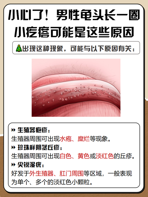 龟头小疙瘩是什么?快速自查男女常见原因(男生龟的头上长一圈小疙瘩是什么) 龟头小疙瘩是什么?快速自查男女常见原因(男生龟的头上长一圈小疙瘩是什么)