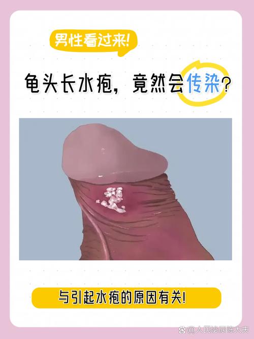 龟头水泡?快查查原因!(龟 头上长了小水泡图片) 龟头水泡?快查查原因!(龟 头上长了小水泡图片)