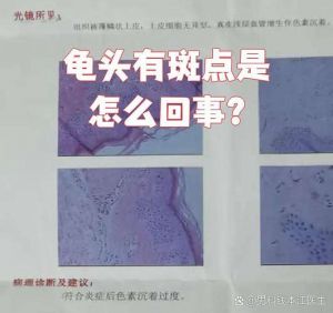龟头黑斑？多注意清洁和卫生！（龟头上有黑斑是什么原因引起的）
