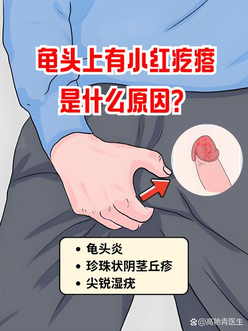 龟头小红点不痛?别大意,快查查原因!(龟 头上小红点不痛不痒) 龟头小红点不痛?别大意,快查查原因!(龟 头上小红点不痛不痒)