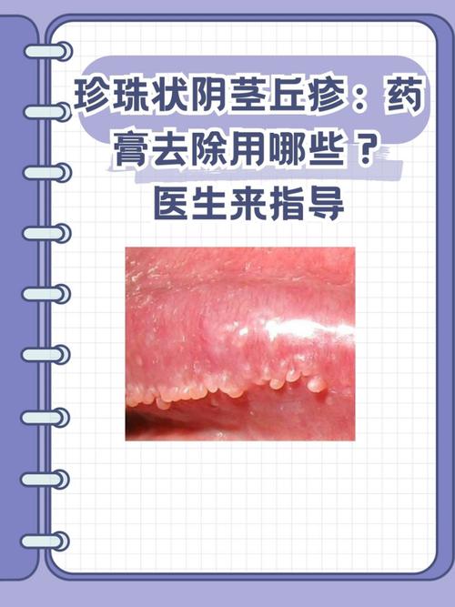 珍珠状小疙瘩,一般无需治疗(龟的头上珍珠疹图片) 珍珠状小疙瘩,一般无需治疗(龟的头上珍珠疹图片)