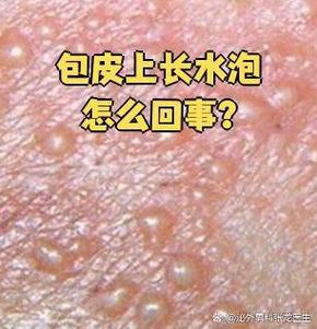 龟头水泡?快查查原因!(龟 头上长了小水泡图片) 龟头水泡?快查查原因!(龟 头上长了小水泡图片)