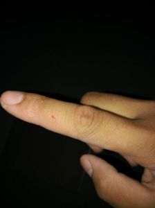 被小狗咬破嘴？别大意，快处理打疫苗！（嘴巴被小狗的牙齿割破了）