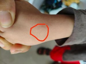 小狗咬伤皮肤红肿像刀划？公园可能是高发地（如何辨别是否被小狗咬到）