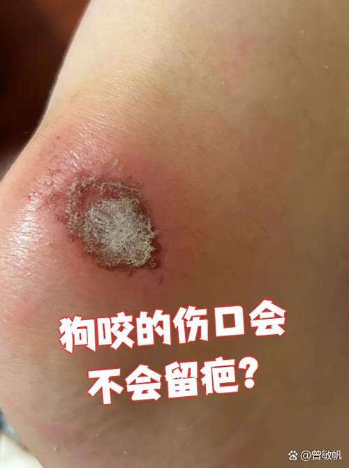 小狗咬破手怎么办?需消毒就医防狂犬(结了疤的手被小狗咬着玩没事吧) 小狗咬破手怎么办?需消毒就医防狂犬(结了疤的手被小狗咬着玩没事吧)