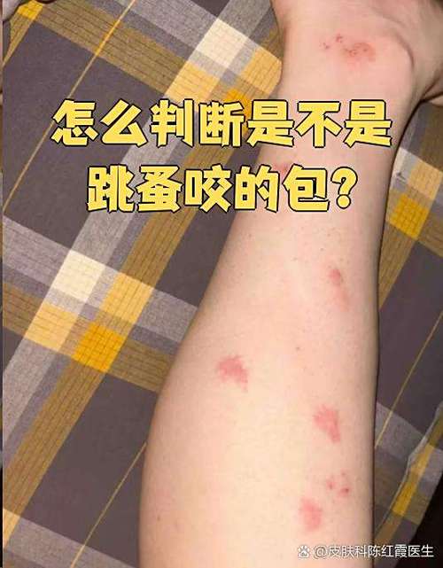 狗咬伤要快处理,别让娃遭殃(狗蹦子咬了图片) 狗咬伤要快处理,别让娃遭殃(狗蹦子咬了图片)
